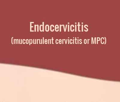 Endocervicitis (mucopurulent cervicitis or MPC)-Standard Treatment Guidelines