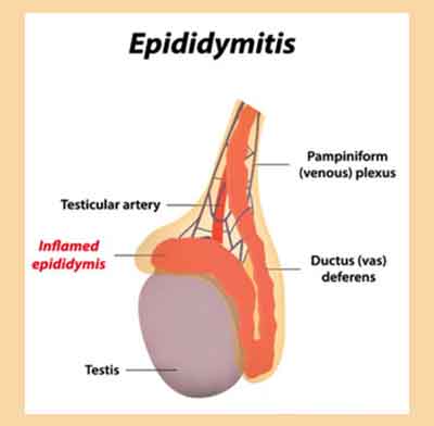 Epididymitis Standard Treatment Guidelines