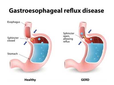 Laparoscopic anti-reflux operation for GERD linked to fewer postoperative complications