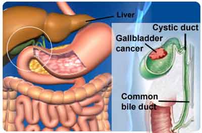 Gall Bladder cancer-Standard Treatment Guidelines