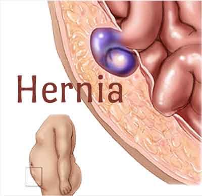 Hernia - Standard Treatment Guidelines