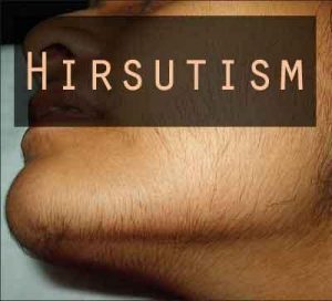 Hirsutism in Premenopausal Women: New Management Guidelines