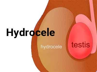 hydrocele treatment