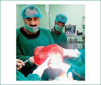 Kashmir: Doctors remove 14 kg Ovarion Cyst from Teenager