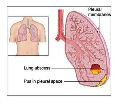 Lung Abscess - Standard Treatment Guidelines