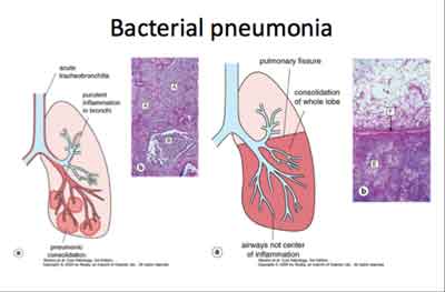 Community Acquired Pneumonia ,Bacterial-Standard Treatment Guidelines