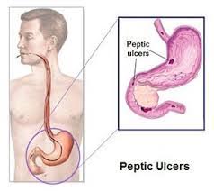 Peptic Ulcer Perforation - Standard Treatment Guidelines