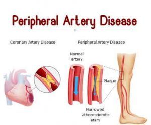 Peripheral Arterial Disease-Standard Treatment Guidelines