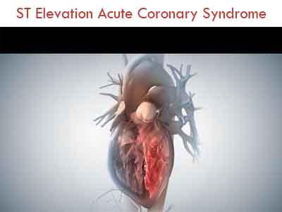 Diagnosis, Treatment of ST Elevation Acute Coronary syndrome- Indian Consensus Document