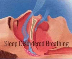 Sleep-Disordered Breathing and Heart Failure