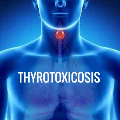 Thyrotoxicosis- Standard Treatment Guidelines