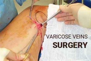 Varicose veins associated with increased risk of DVT : JAMA