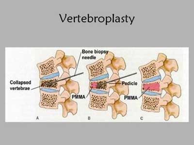 Vertebroplasty-Standard Treatment Guidelines