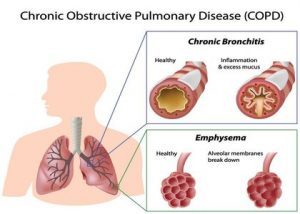 COPD exacerbations in those with CVD increases heart, stroke risk