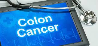 New stool test- at home screening option for colorectal cancer