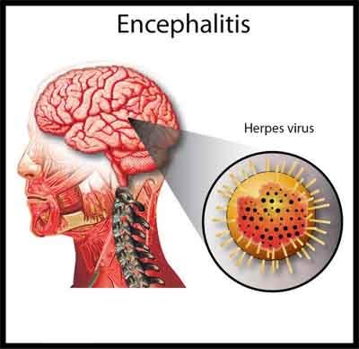 New treatment for a rare form of encephalitis