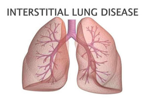 Low vitamin D levels associated with interstitial lung disease