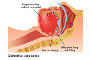 New disposable diagnostic patch for detecting Sleep Apnea