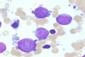 Improved treatment for chronic myeloid leukemia by inhibiting leukemia stem cells