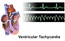 Clinical trial-New technique to treat life-threatening ventricular tachycardia