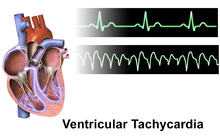 Ranolazine doesnt prevent ventricular arrhythmias in patients with ICDs-JACC