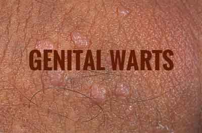 Genital Warts-Standard Treatment Guidelines