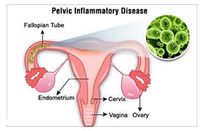 pelvic inflammatory disease bacteria