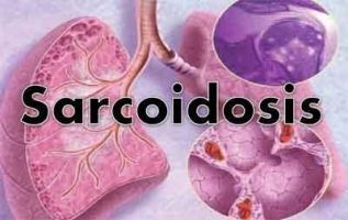 Sarcoidosis-Standard Treatment Guidelines