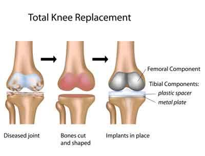 Knee replacement timing not right for all-Its too soon or too late