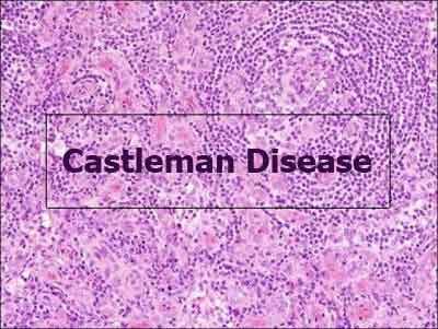 First diagnostic criteria for idiopathic multicentric castleman disease