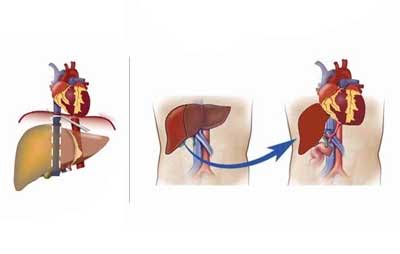 First liver transplant carried out in Puducherry