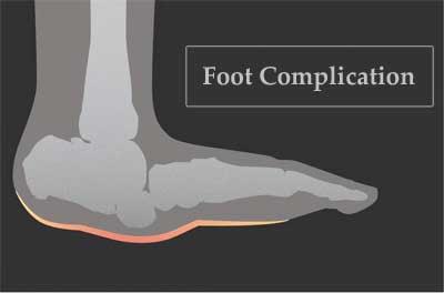 Study: Two-thirds of clinicians lack knowledge of diabetes related foot complication