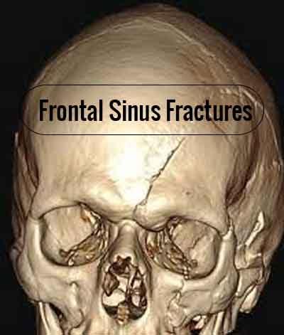 Minimally disruptive treatment protocol for frontal sinus fractures: JAMA