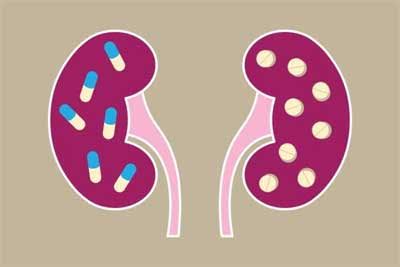 Popular Proton Pump Inhibitors linked to gradual yet silent kidney damage: Study
