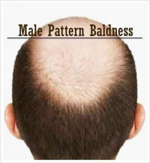 Study of 52,000 men uncovers the genetics underlying male pattern baldness