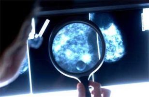 Breast MRIs lead to more biopsies which detect fewer cancers : JAMA