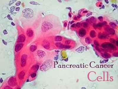 Scientists identify aggressive pancreatic cancer cells and their vulnerability