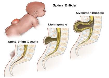 Two babies with spina bifida treated while still in womb