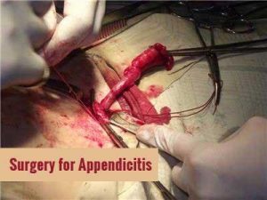 Antibiotics can become alternative to surgery for appendicitis: Study