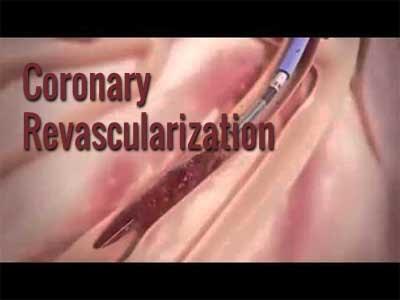 Complete revascularization PCI has better outcomes than culprit-only PCI