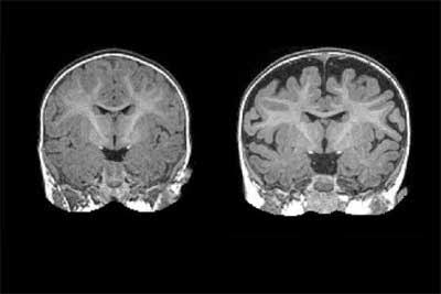 MRI contrast agents accumulate in the brain :Lancet study