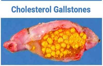 Study indicates New approach to prevent and treat cholesterol gallstones
