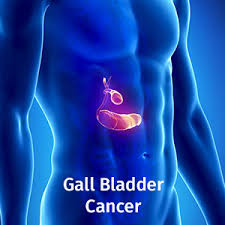 Study finds common gene variants linked to gall bladder cancer