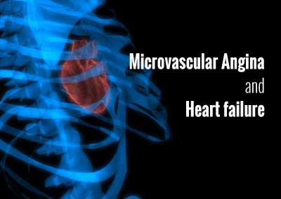 How to approach recurrent angina following Angioplasty- find out