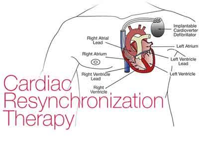 Wireless LV Endocardial Pacing for cardiac resynchronization therapy