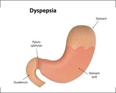 Updated 2018 Thailand Dyspepsia Guidelines