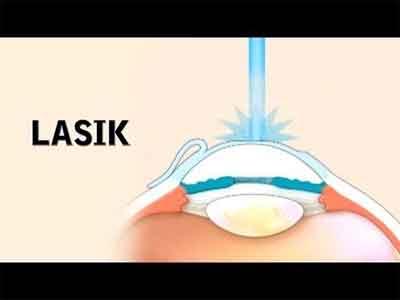 Lower risk of infection with LASIK than with contacts over time: Analysis