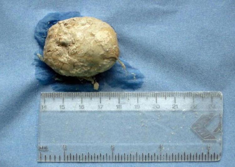 Indias biggest bladder stone weighing 1.4 kg removed: Doctor