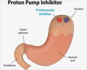 USE PPI as per latest guidelines by American Gastroenterological Association