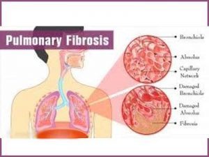 Antibody is effective against radiation-induced pulmonary fibrosis